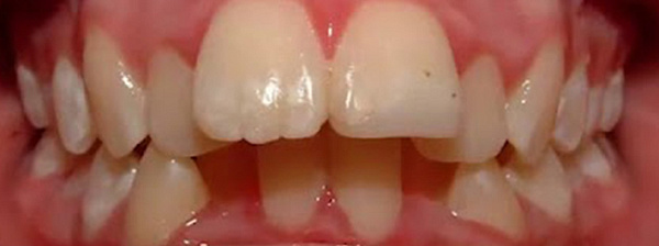 Сужение зубного ряда
