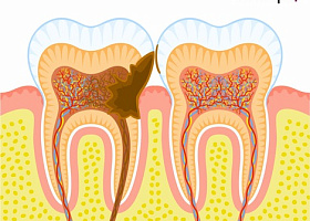 Как зубная нить может спасти от удаления зубов