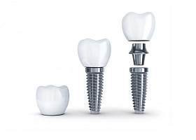 Скидка 12 000 руб. на установку зубных имплантатов имплантация со скидкой во владимирской стоматологии